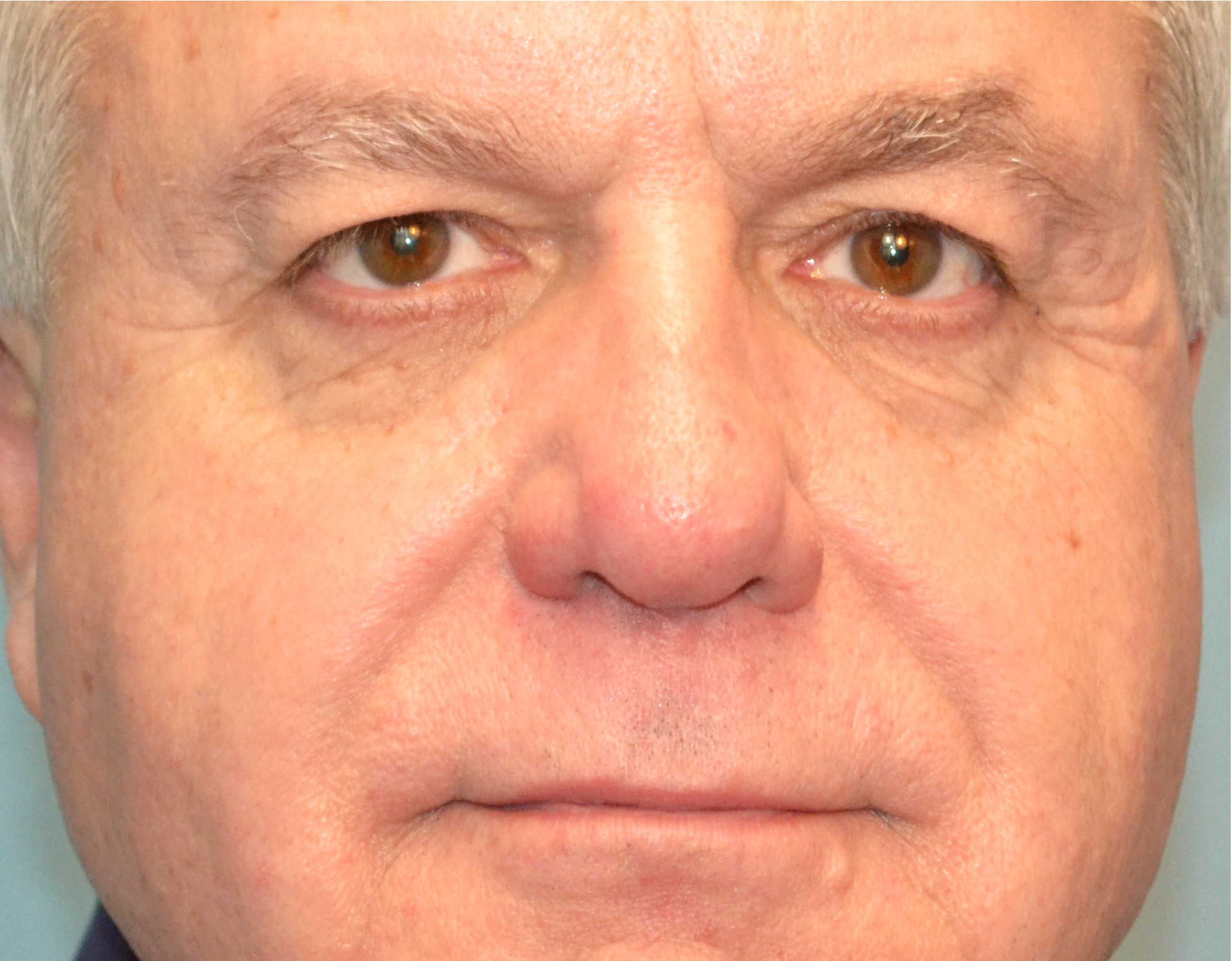 Eyelid Surgery (Blepharoplasty) Before & After Case 6