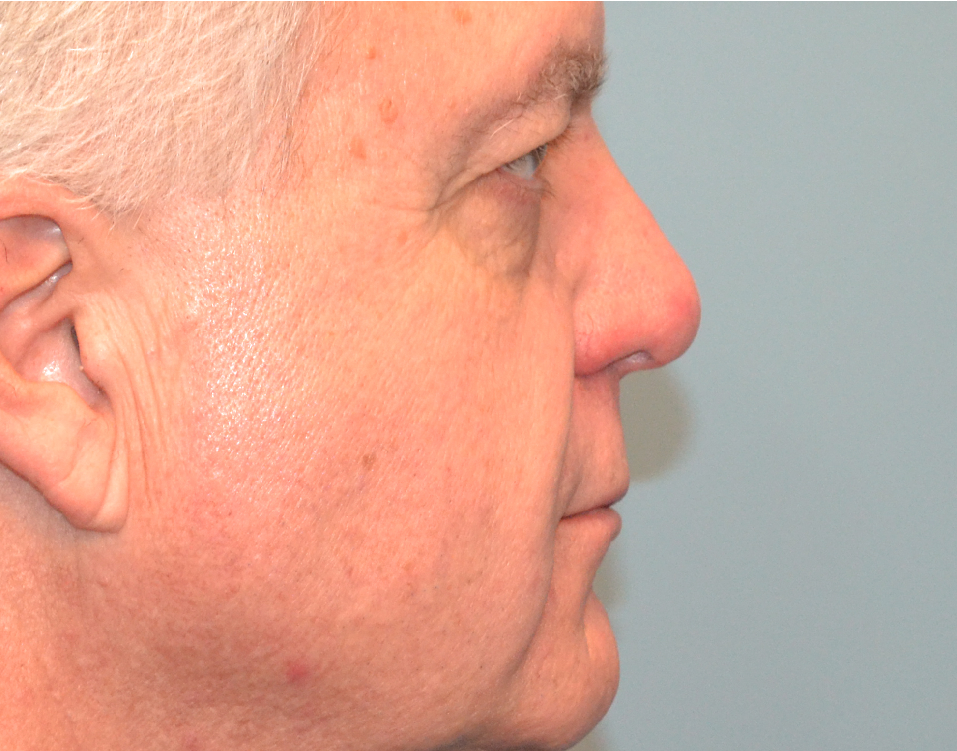 Eyelid Surgery (Blepharoplasty) Before & After Case 6