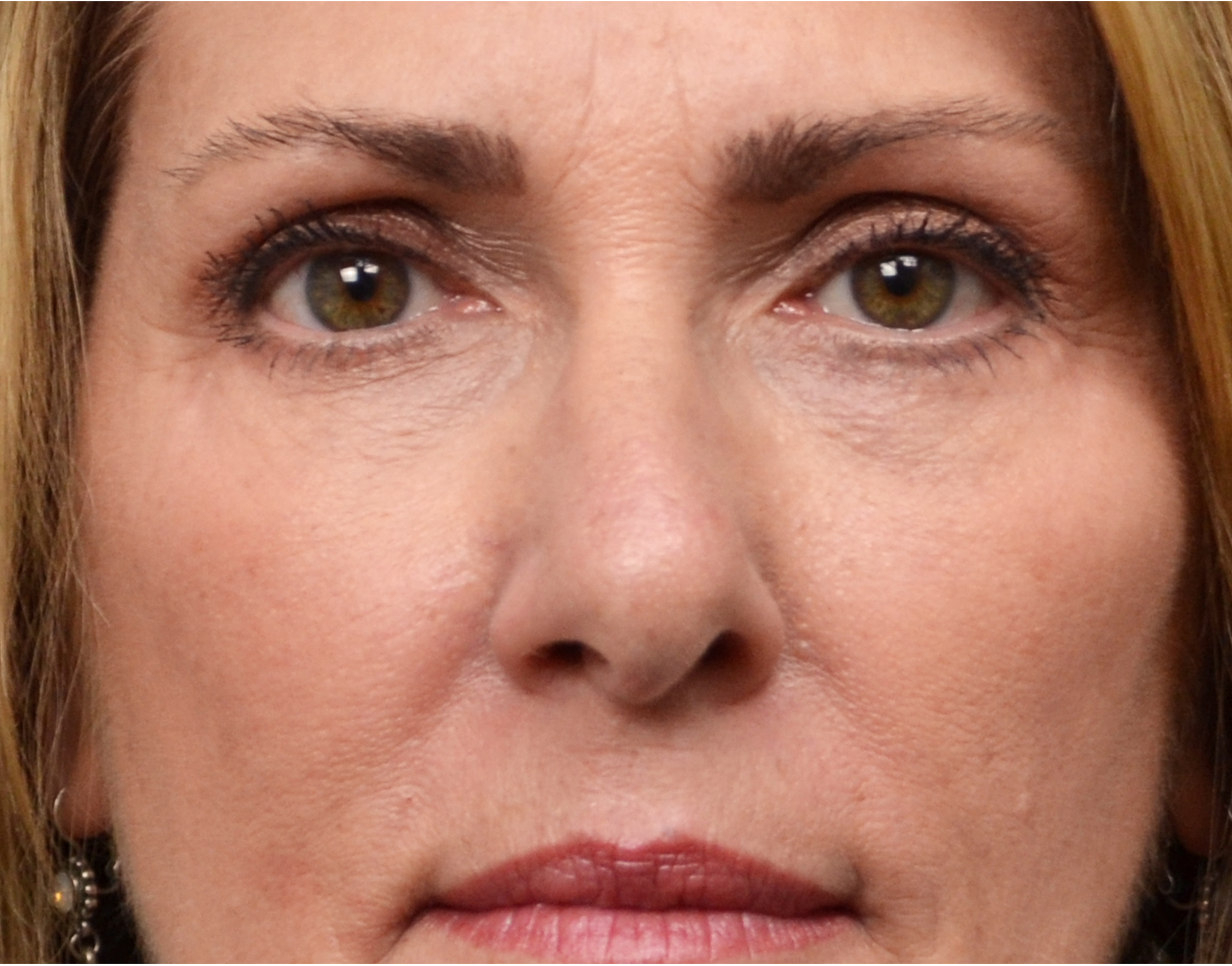 Eyelid Surgery (Blepharoplasty) Before & After Case 7