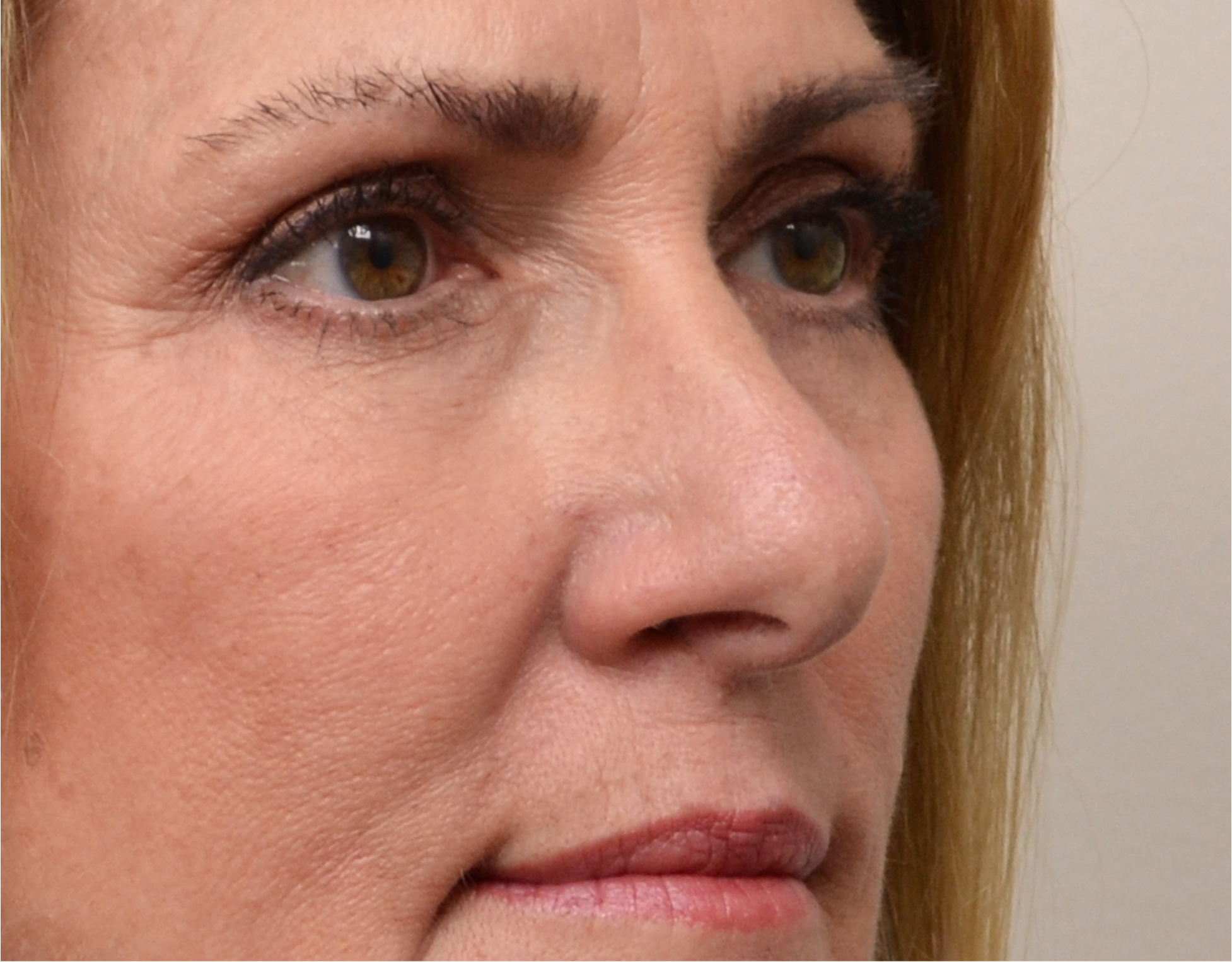 Eyelid Surgery (Blepharoplasty) Before & After Case 7