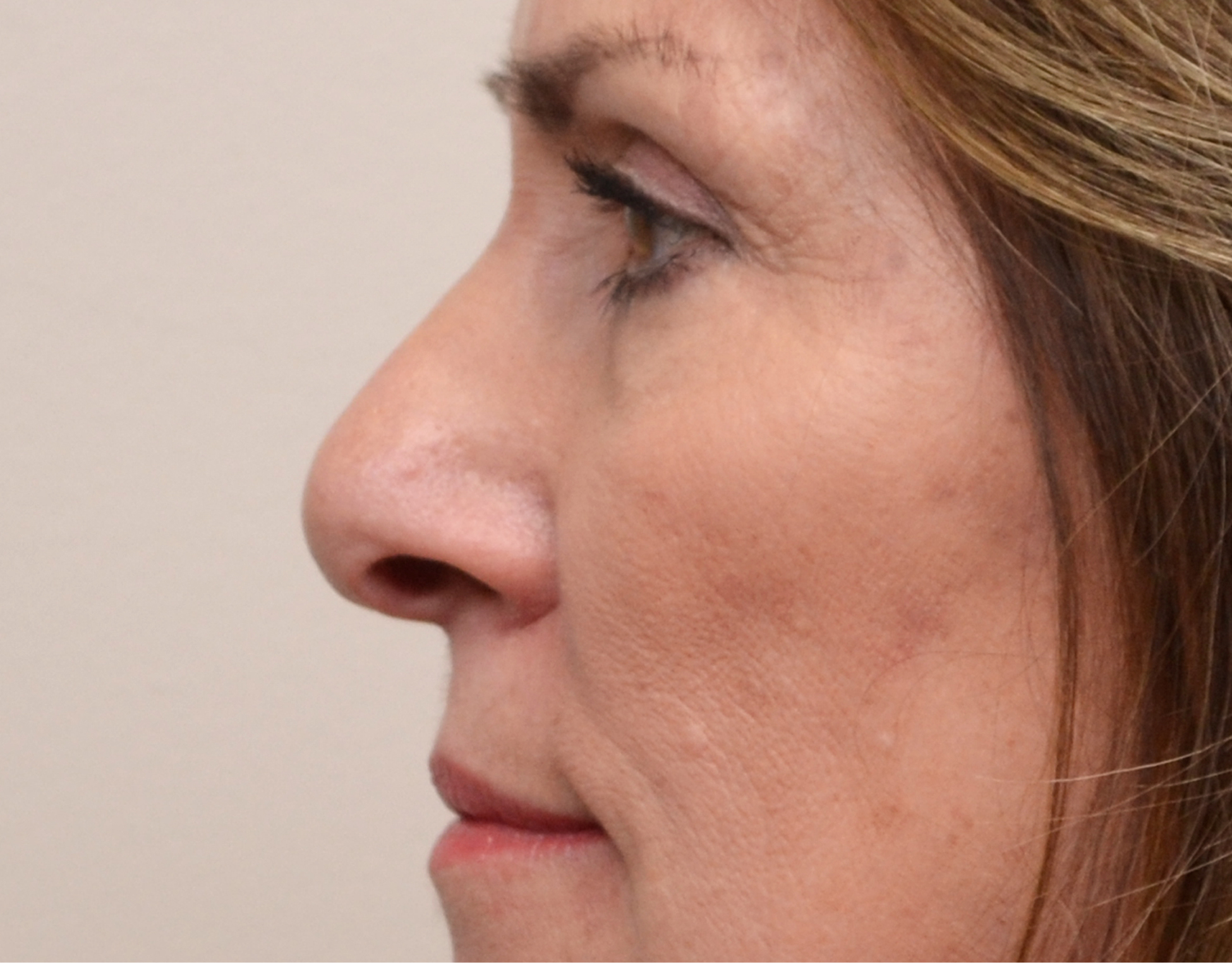 Eyelid Surgery (Blepharoplasty) Before & After Case 7