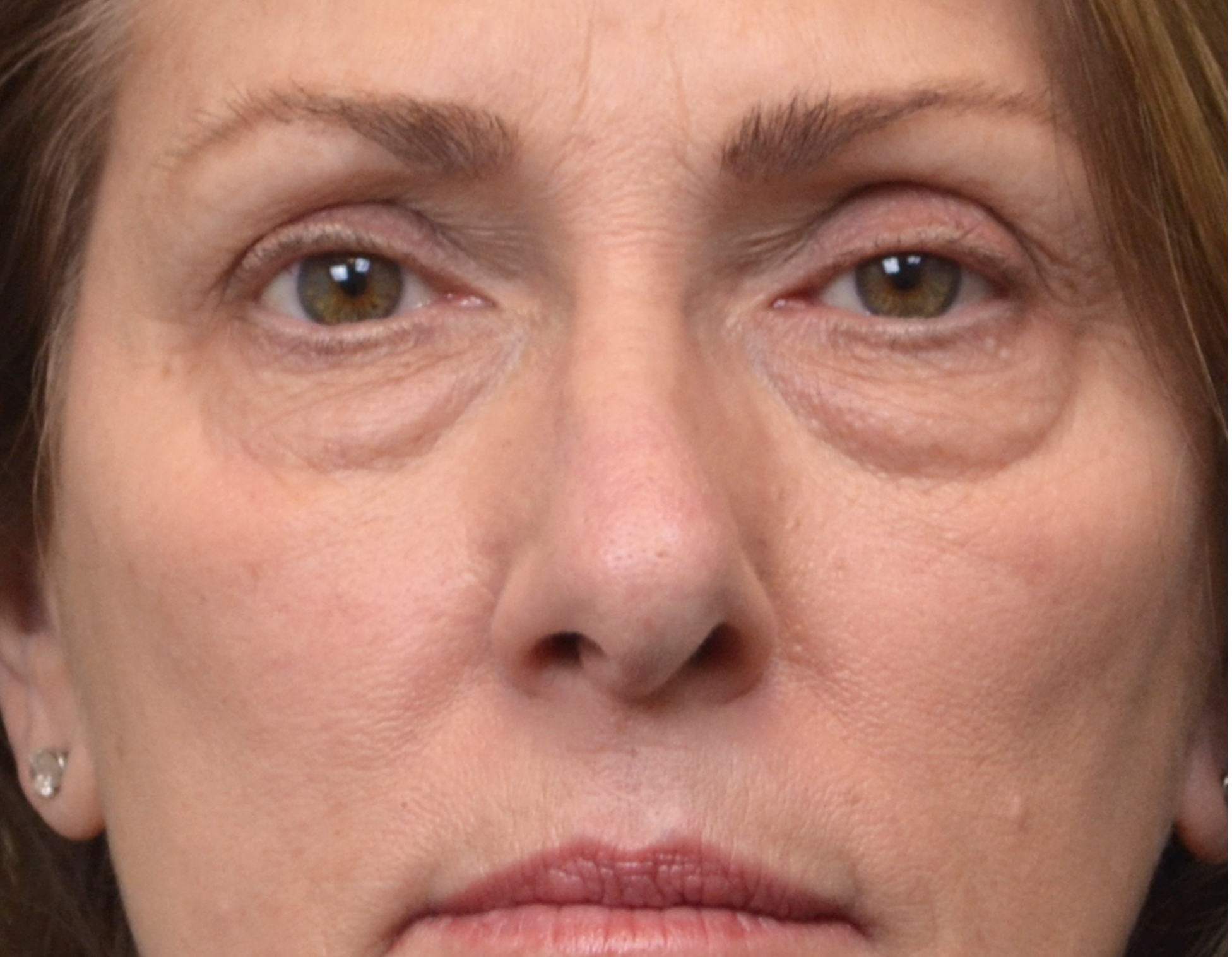 Eyelid Surgery (Blepharoplasty) Before & After Case 7