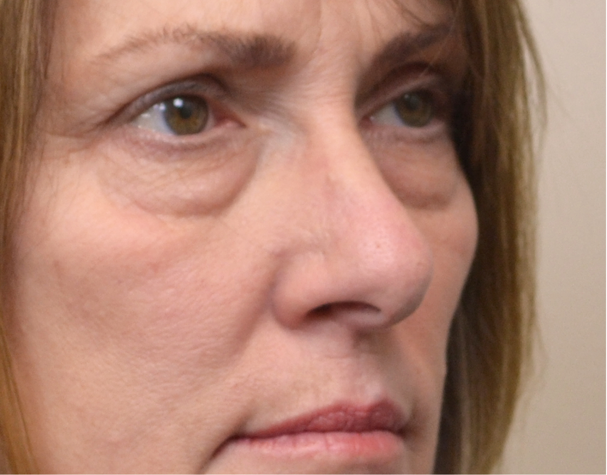 Eyelid Surgery (Blepharoplasty) Before & After Case 7