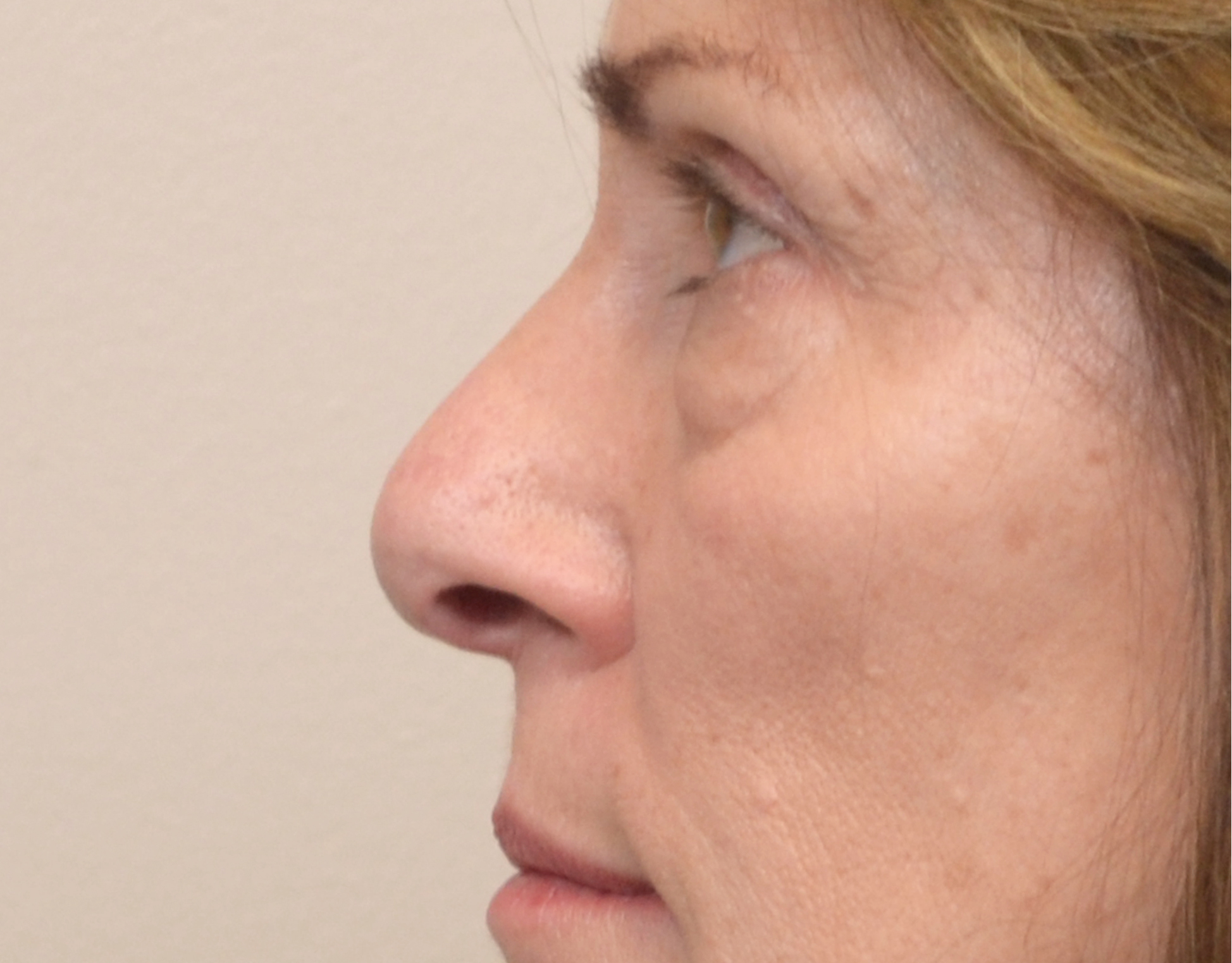 Eyelid Surgery (Blepharoplasty) Before & After Case 7