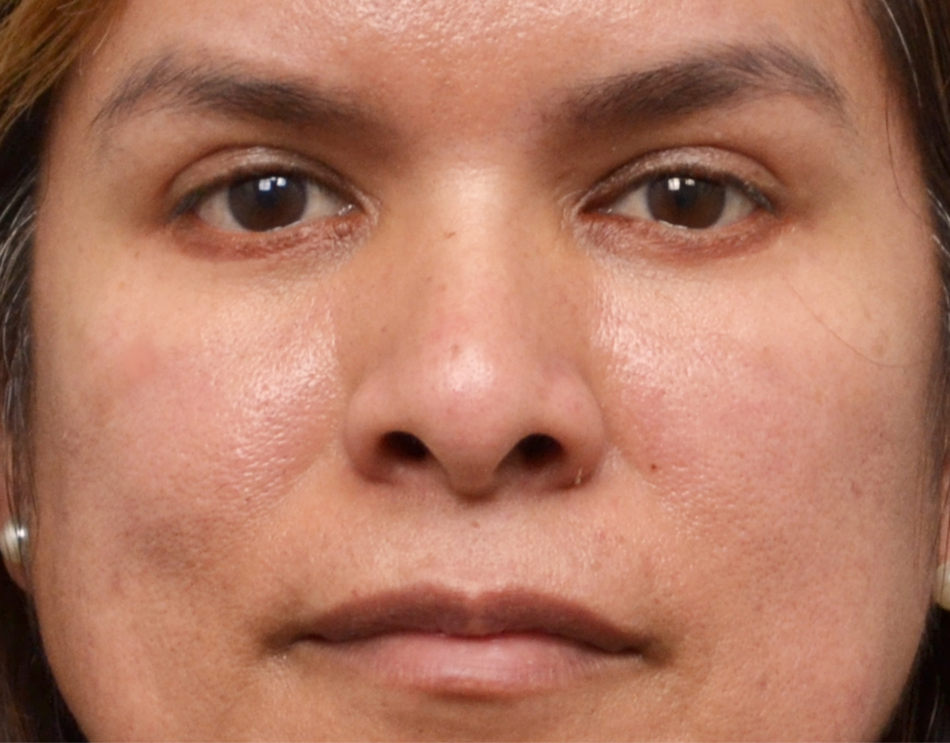 Eyelid Surgery (Blepharoplasty) Before & After Case 8