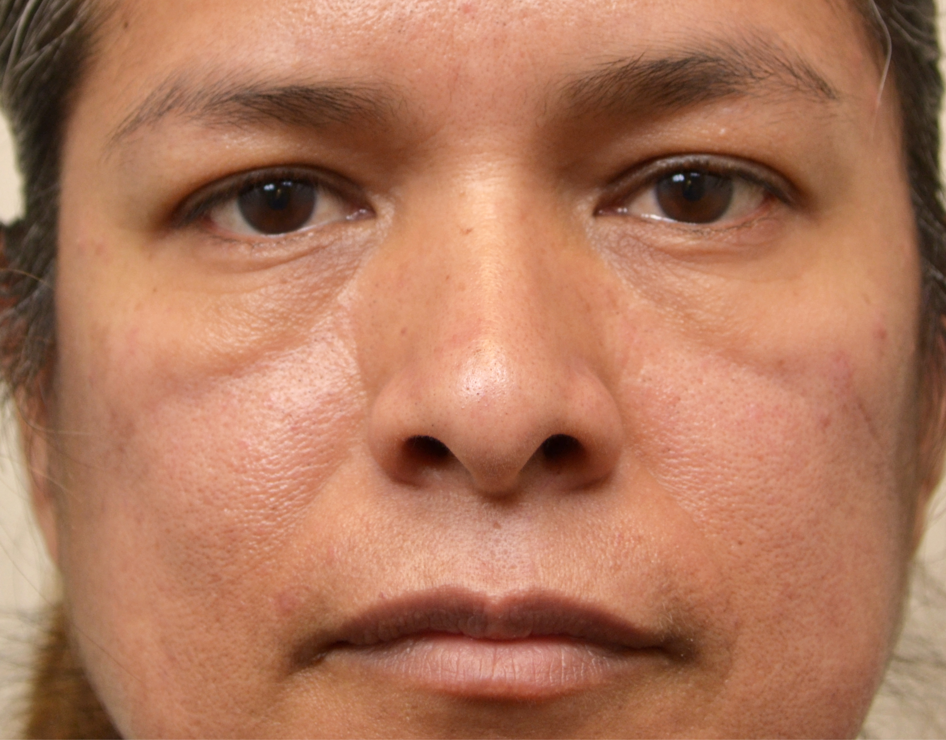 Eyelid Surgery (Blepharoplasty) Before & After Case 8