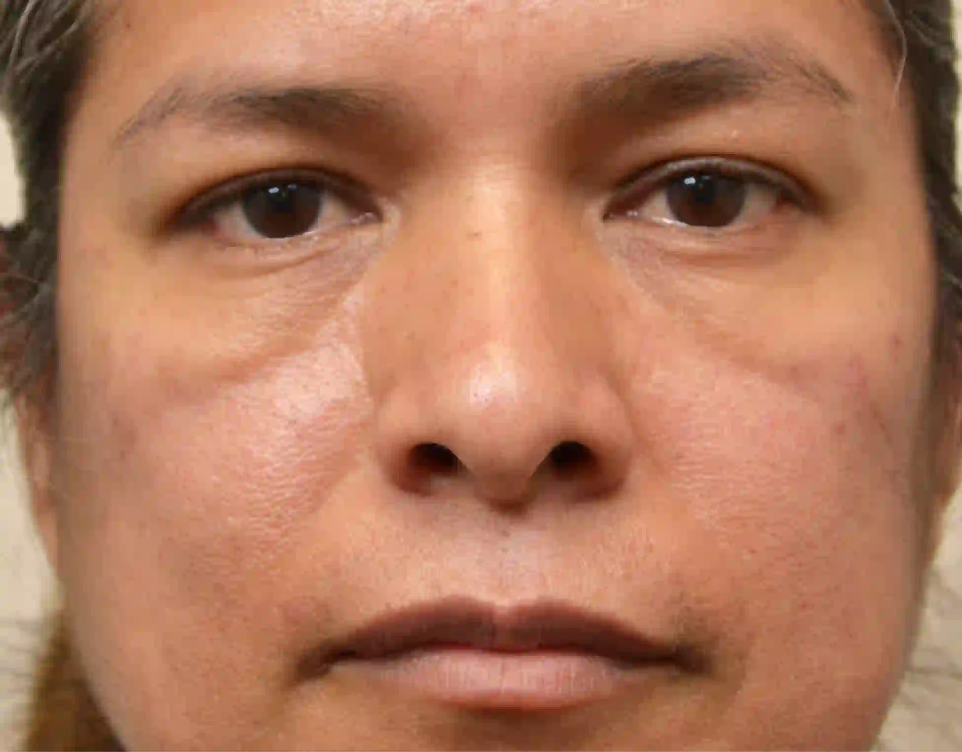 Case 8 Blepharoplasty b2