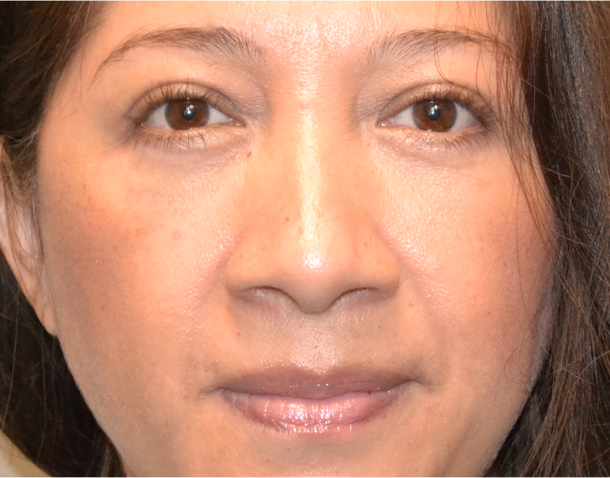 Eyelid Surgery (Blepharoplasty) Before & After Case 9