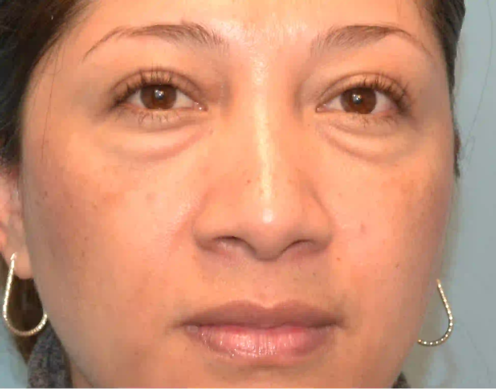 Case 9 Lower Blepharoplasty b1