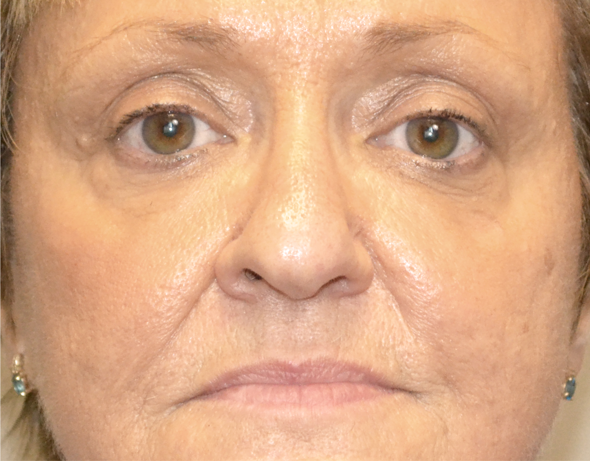 Eyelid Surgery (Blepharoplasty) Before & After Case 10